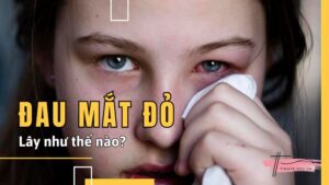 Đau mắt đỏ lây như thế nào - Có phải nhìn nhau cũng bị lây?