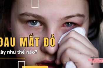 Đau mắt đỏ lây như thế nào – Có phải nhìn nhau cũng bị lây?