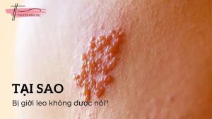 Giải đáp nhanh: Tại sao bị giời leo không được nói
