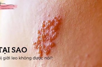 Giải đáp nhanh: Tại sao bị giời leo không được nói