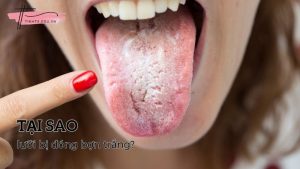Tại sao lưỡi bị đóng bợn trắng? Cách điều trị đơn giản tại nhà