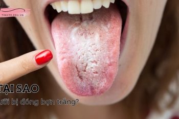 Tại sao lưỡi bị đóng bợn trắng? Cách điều trị đơn giản tại nhà