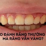 Tại sao đánh răng thường xuyên mà răng vẫn vàng ố, xỉn màu?
