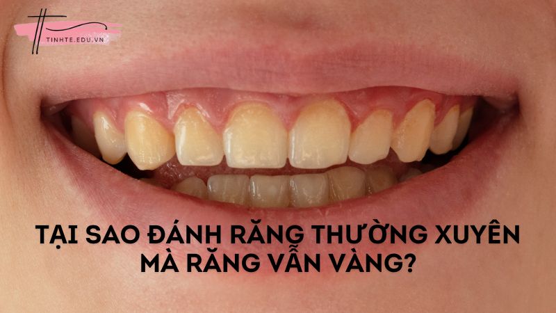 Tại sao đánh răng thường xuyên mà răng vẫn vàng?